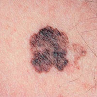 Skin Cancer Symptoms & Pictures | Carolinas Skin Center