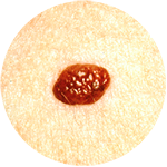 cherry-angioma