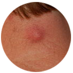 epidermoid-cyst