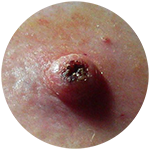 keratoacanthoma