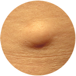 lipoma