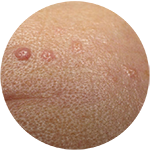 sebaceous-hyperplasia-senile-hyperplasia